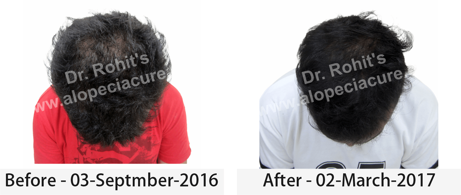 hair loss treatment